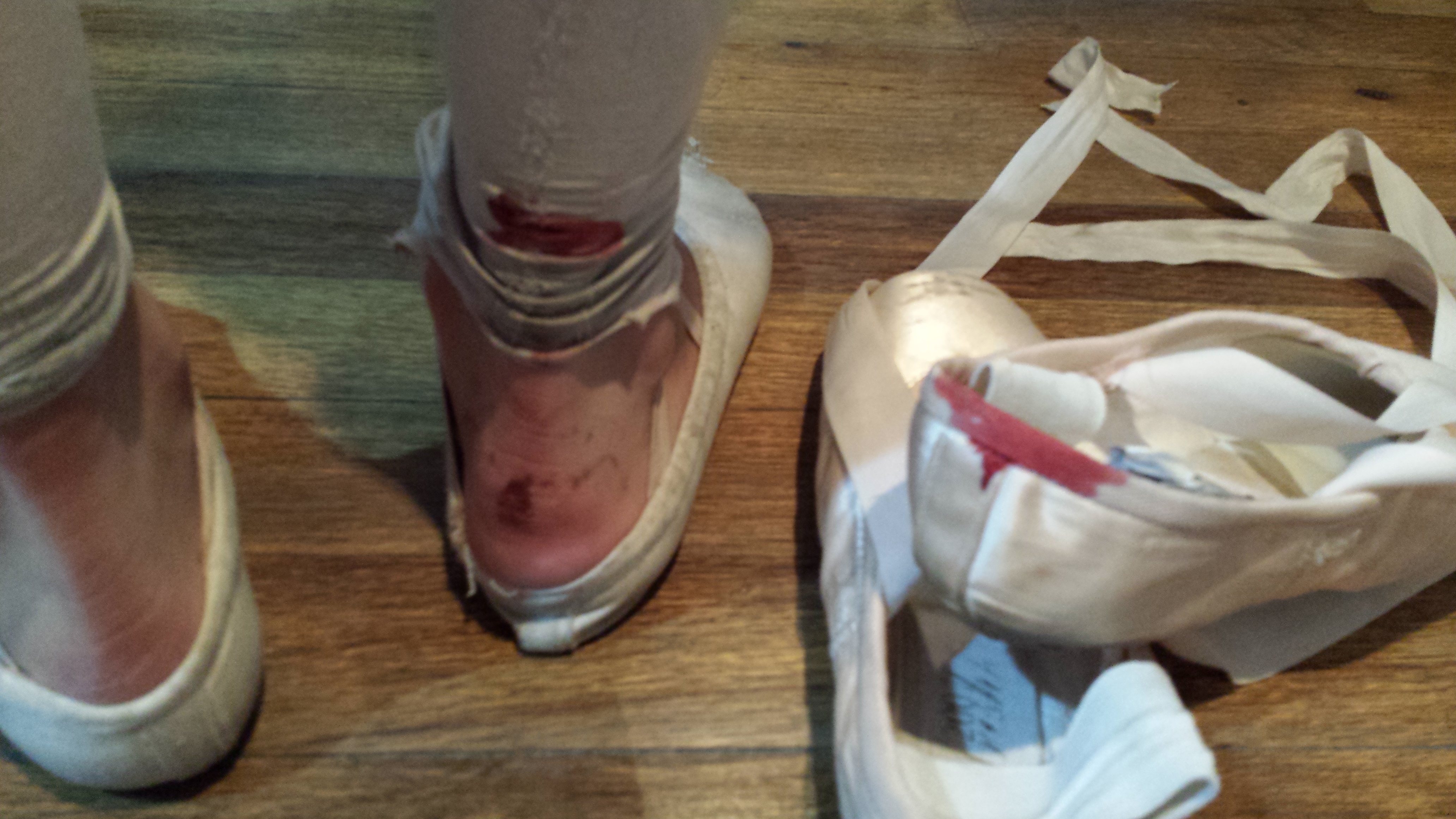 Pointe Shoes: Do You Get Blisters or Calluses?